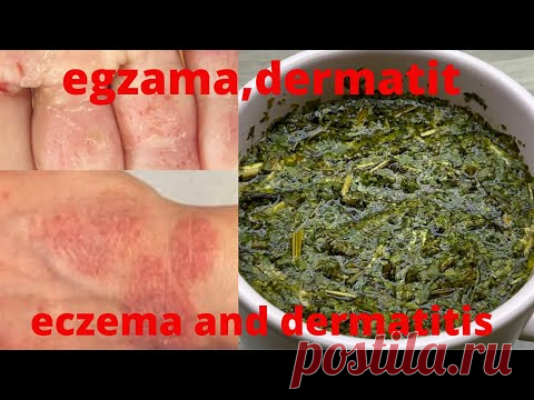 Как вылечить экзему, кожный дерматит и аллергию за 1 неделю