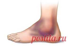 Отек голеностопного сустава лечение