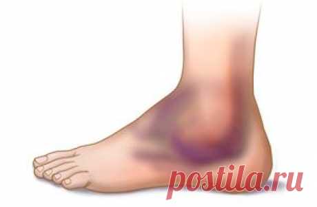 Отек голеностопного сустава лечение