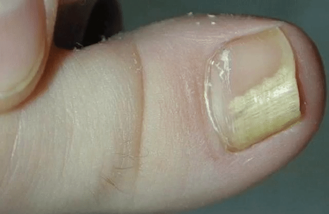 ЛУЧШЕЕ ДОМАШНЕЕ СРЕДСТВО ОТ ГРИБКА НОГТЕЙ, ВСЕГО ИЗ 2 ИНГРЕДИЕНТОВ!
Пожелтение
 и отслаивание ногтевой пластины, появление трещинок и зуд между 
пальцами — симптомы грибковой инфекции. Статистика свидетельствует, что 
каждый 5-й житель Земли страдает от этой проблемы.
Сниженный 
иммунитет, тесная обувь, излишняя потливость ног, лишний вес — факторы, 
способствующие заражению. Если вы заметили у себя на ногах проявления 
грибка, следует действовать незамедлительно!
Средства...