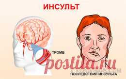 Еще одно грозное заболевание от которого никто не застрахован. Я говорю об инсульте. Инсульт-это нарушение мозгового кровообращения. #отзыв #инсульт #мозговое #кровообращение