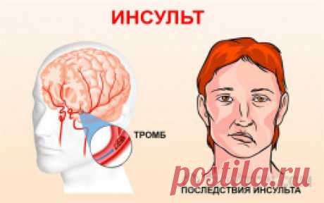 Еще одно грозное заболевание от которого никто не застрахован. Я говорю об инсульте. Инсульт-это нарушение мозгового кровообращения. #отзыв #инсульт #мозговое #кровообращение