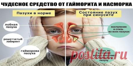 ЧУДЕСНОЕ СРЕДСТВО ОТ ГАЙМОРИТА И НАСМОРКА С похолоданием приходят простудные заболевания, и особенно неприятный симптом - насморк или, не дай Бог, гайморит... Часто врачи сразу направляют на прокол, что,собственно,не столько лечит,сколько калечит... Есть проверенный рецепт от гайморита, помогает на 100%. Берешь
