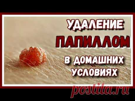 КАК я удалила ПАПИЛЛОМУ. Делюсь ОПЫТОМ. Удаление папиллом в ДОМАШНИХ условиях.