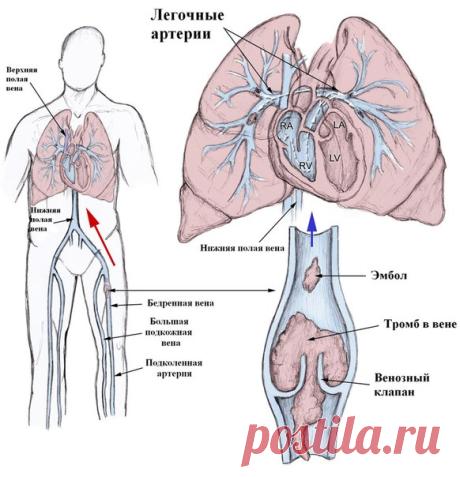 Профилактика образования тромбов

1. Пейте больше воды! 90% людей пьют очень мало воды. Речь именно о кипяченой природной воде, а не о жидкостях. Взрослый человек должен выпивать ежедневно 2-2,5 литра воды. В жару еще больше. Приучайте своих детей пить воду. Натуральная вода — первое и очень мощное средство против образования тромбов.

2. Продукты для разжижения крови:

- оливковое и льняное масло;
- яблочный уксус;
- чеснок и лук (регулярное потребление чеснока наполовину...