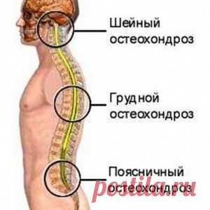 ОСТЕОХОНДРОЗ. - МирТесен