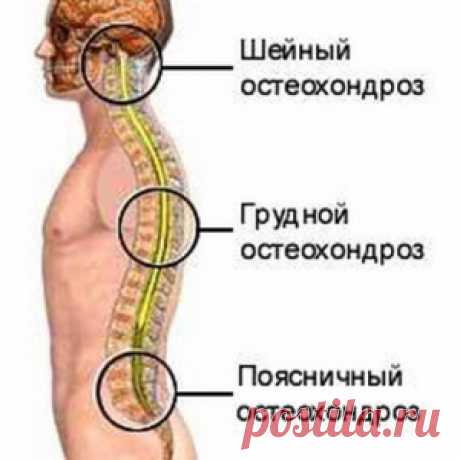 ОСТЕОХОНДРОЗ. - МирТесен