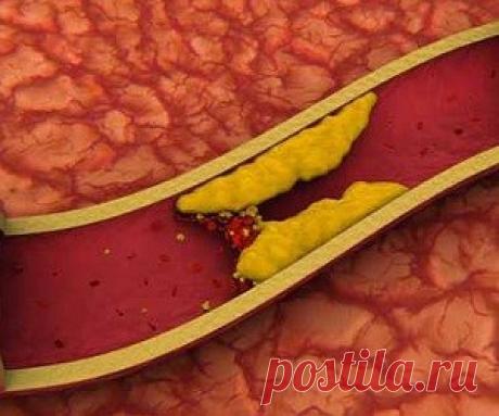 ТОП-6 натуральных средств для очищения артерий - Медицина 2.0