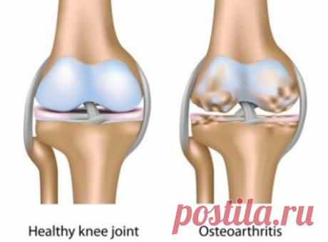 БОЛЬНЫЕ СУСТАВЫ И КОЛЕНИ БОЯТСЯ ЭТОГО КАК ОГНЯ! ЧИТАЙТЕ, ПОКА НЕ УДАЛИЛИ…