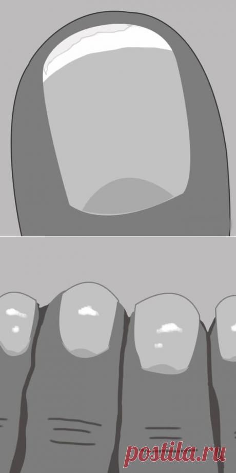 О чем на самом деле говорят белые пятна на ногтях и другие сигналы организма