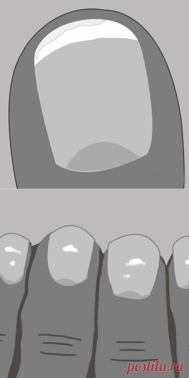 О чем на самом деле говорят белые пятна на ногтях и другие сигналы организма