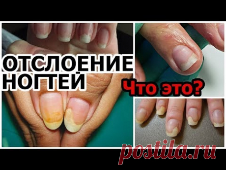 ОНИХОЛИЗИС (Отслоение ногтей): Причины, Диагностика, Устранение.