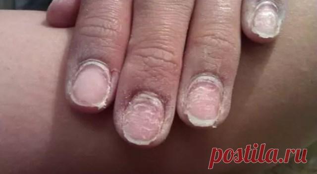 Чем грозит гель-лак вашим ногтям. Прочесть всем! Страшный факт о гель-лаке! Наращивание ногтей гель-лаком — модная процедура, ведь держится такой маникюр до 3-х недель. Он мог бы и дольше. только ногти