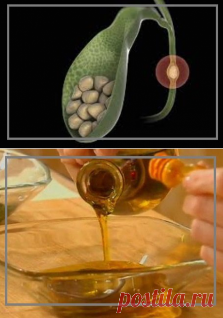 Мед и растительное масло растворяют камни в желчном пузыре | моя записная книжка | Яндекс Дзен
