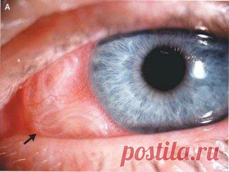 Гельминты в глазах – симптомы