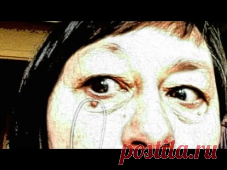 ПАПИЛЛОМЫ. Как я сама удалила большую папиллому под глазом .