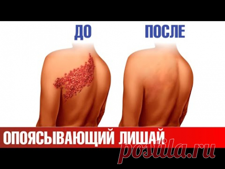 Опоясывающий лишай: лучшая стратегия👉атака изнутри и снаружи