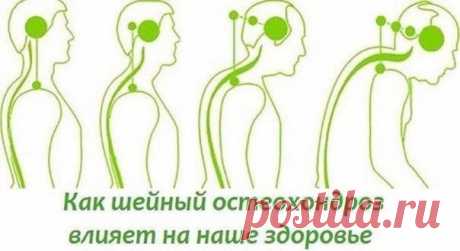 О шейном остеохондрозе

На начальном этапе изменения претерпевают кости и связки. И о том наш организм сигнализирует периодической болью или нарушением чувствительности отдела, пораженного остеохондрозом. Затем появляются трещины и меняется высота стояния диска, а точки прикрепления мышц и связок, принадлежащие двум соседним позвонкам, сближаются.

Поэтому мышцы и связки провисают и позвонки начинают легко соскальзывать или смещаться относительно друг друга. Тогда к боли д...