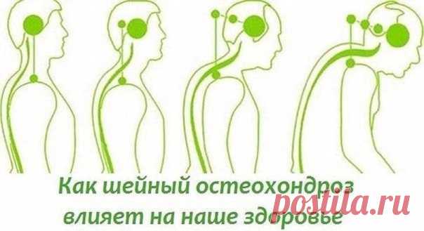 О шейном остеохондрозе

На начальном этапе изменения претерпевают кости и связки. И о том наш организм сигнализирует периодической болью или нарушением чувствительности отдела, пораженного остеохондрозом. Затем появляются трещины и меняется высота стояния диска, а точки прикрепления мышц и связок, принадлежащие двум соседним позвонкам, сближаются.

Поэтому мышцы и связки провисают и позвонки начинают легко соскальзывать или смещаться относительно друг друга. Тогда к боли д...