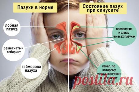 Как лечить гайморит в домашних условиях