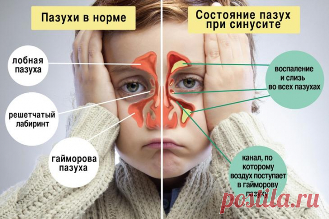 Как лечить гайморит в домашних условиях