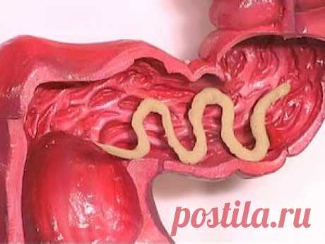 Как узнать что у тебя аскариды и как вылечить их?