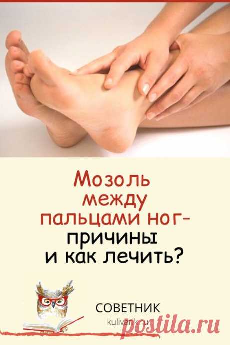 Мозоль между пальцами ног: причины и как лечить?