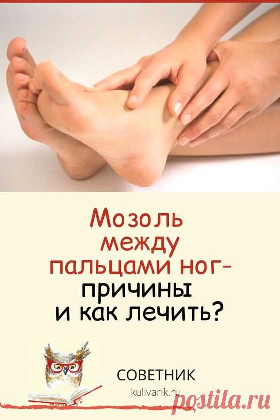 Мозоль между пальцами ног: причины и как лечить?