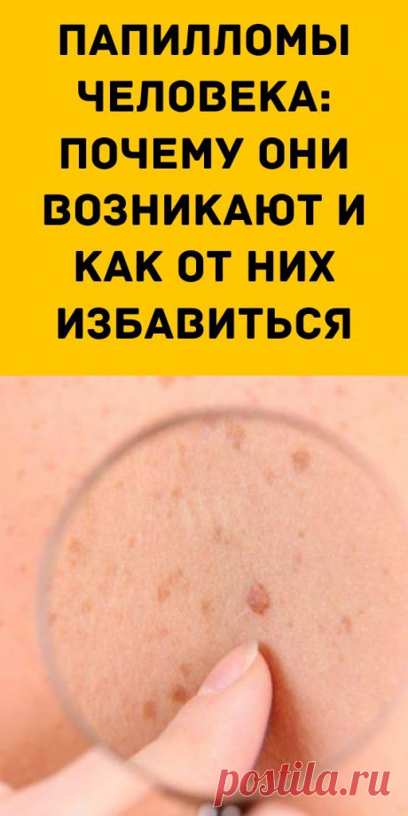 Папилломы человека: почему они возникают и как от них избавиться