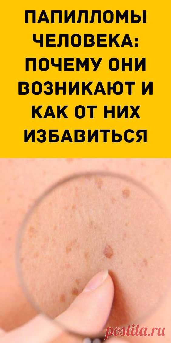 Папилломы человека: почему они возникают и как от них избавиться