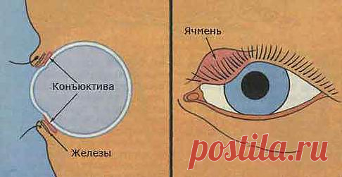 ЯЧМЕНЬ ГЛАЗ. НАРОДНЫЕ МЕТОДЫ ЛЕЧЕНИЯ ЯЧМЕНЯ ГЛАЗ .
