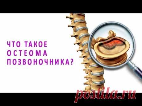 Что такое остеома позвоночника и как она лечится?