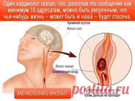 Распознавание симптомов инсульта
Три основных приёма распознавания симптомов инсульта (УЗП):
У — Попросите пострадавшего УЛЫБНУТЬСЯ.
З — Попросите его ЗАГОВОРИТЬ. Попросить выговорить простое предложение. Связно. Например: «За окном светит солнце»
П — Попросите его ПОДНЯТЬ обе руки.