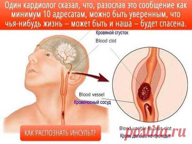 Распознавание симптомов инсульта
Три основных приёма распознавания симптомов инсульта (УЗП):
У — Попросите пострадавшего УЛЫБНУТЬСЯ.
З — Попросите его ЗАГОВОРИТЬ. Попросить выговорить простое предложение. Связно. Например: «За окном светит солнце»
П — Попросите его ПОДНЯТЬ обе руки.