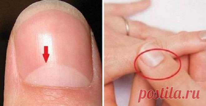ЗНАЕТЕ ЛИ ВЫ, ЧТО ОЗНАЧАЕТ ПОЛУМЕСЯЦ НА НОГТЯХ? Ответ намного ВАЖНЕЕ, чем вы думаете! Это беловатая область вокруг ногтей, является чувствительной и важной частью структуры ногтя. Существует представление о том, что о наличии некоторых заболеваний внутренних органов можно узнать по раз
