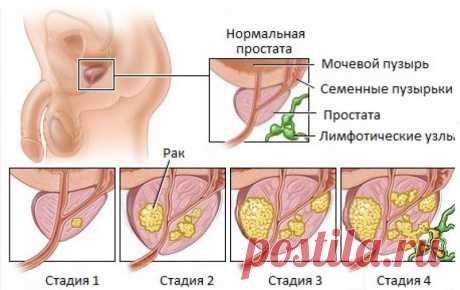 Рак простаты, предстательной железы, клиника Й.Витта