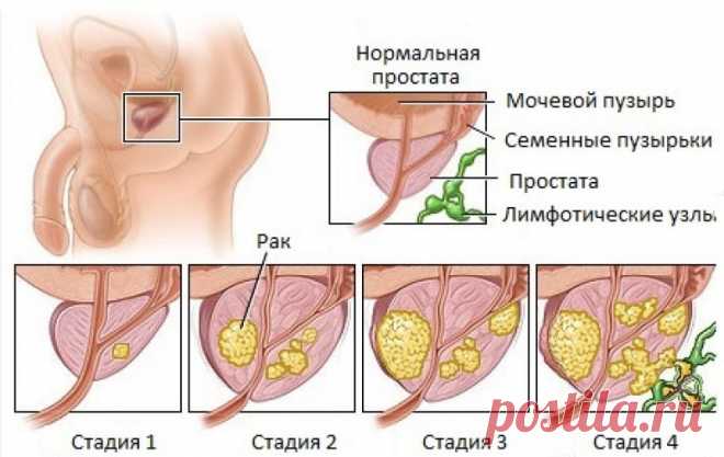Рак простаты, предстательной железы, клиника Й.Витта