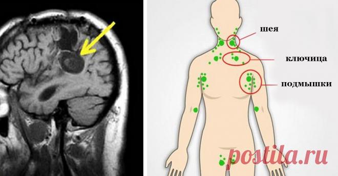 Вот, что провоцирует и ускоряет рост клеток рака в нашем теле! Узнай лучшие способы, чтобы остановить это!