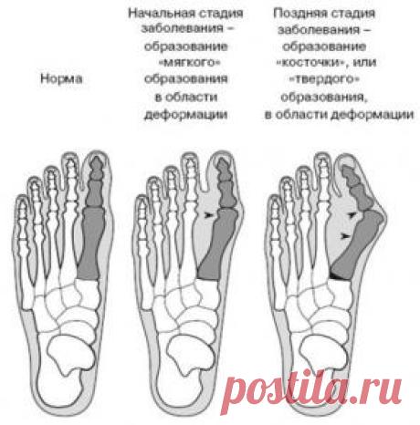 Народные методы лечения косточки на ногах