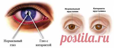 Как распознать катаракту | Делимся советами