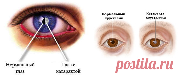 Как распознать катаракту | Делимся советами