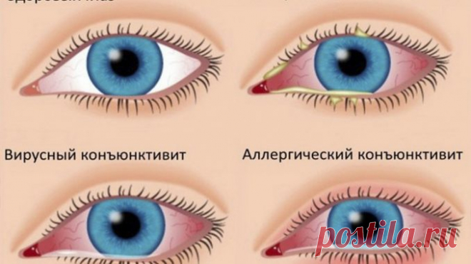 Коньюктивит — лечение народными средствами — Умный совет