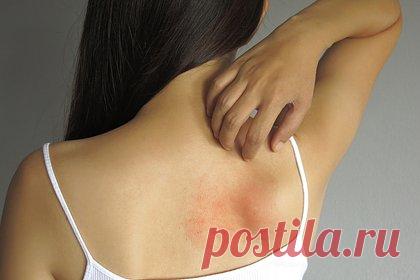 Девушка пожаловалась на аллергическую реакцию из-за бойфренда. 22-летней Вирджинии Нолт из Массачусетса, США, уверена, что страдает от аллергической реакции на бойфренда. Впервые она заметила зуд и покраснения на коже после знакомства с молодым человеком. Симптомы ухудшились, когда девушка стала проводить выходные в квартире возлюбленного.