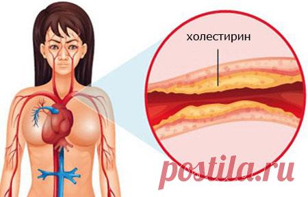 Холестериновые бляшки - как очистить сосуды?