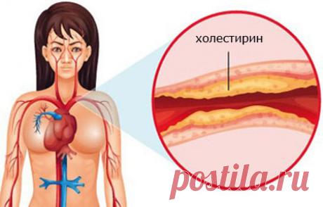 Холестериновые бляшки - как очистить сосуды?
