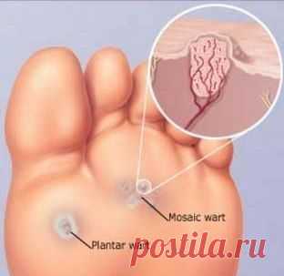 Действенный рецепт от бородавок Секреты женского здоровья!