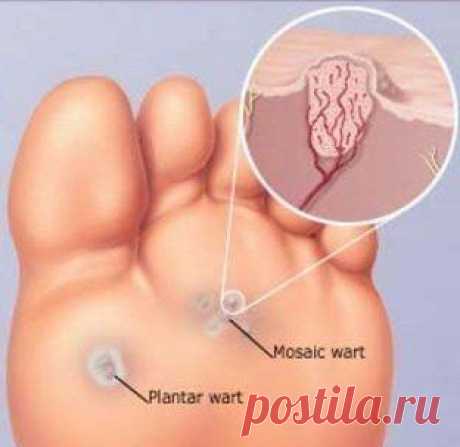 Действенный рецепт от бородавок Секреты женского здоровья!