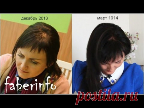 Как убрать ЗАЛЫСИНУ за 3 месяца! ДО И ПОСЛЕ /  Duсray