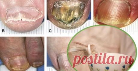 Они называют это «убийцей грибка», потому что он устраняет все грибки ногтей
Невероятное средство!
Грибки, которые находятся на ногтях, вызывают состояние, называемое онхомикозом.
Это приводит к тому, что ногти имеют цвет, который не нравится глазу, плюс вы может…