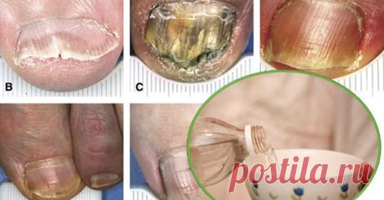Они называют это «убийцей грибка», потому что он устраняет все грибки ногтей 


Невероятное средство!







 


Грибки, которые находятся на ногтях, вызывают состояние, называемое онхомикозом.
Это приводит к тому, что ногти имеют цвет, который не нравится глазу, плюс вы может…